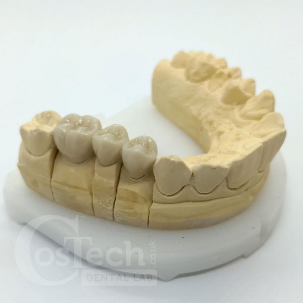 Demonstration Model: BruxZir Bridge