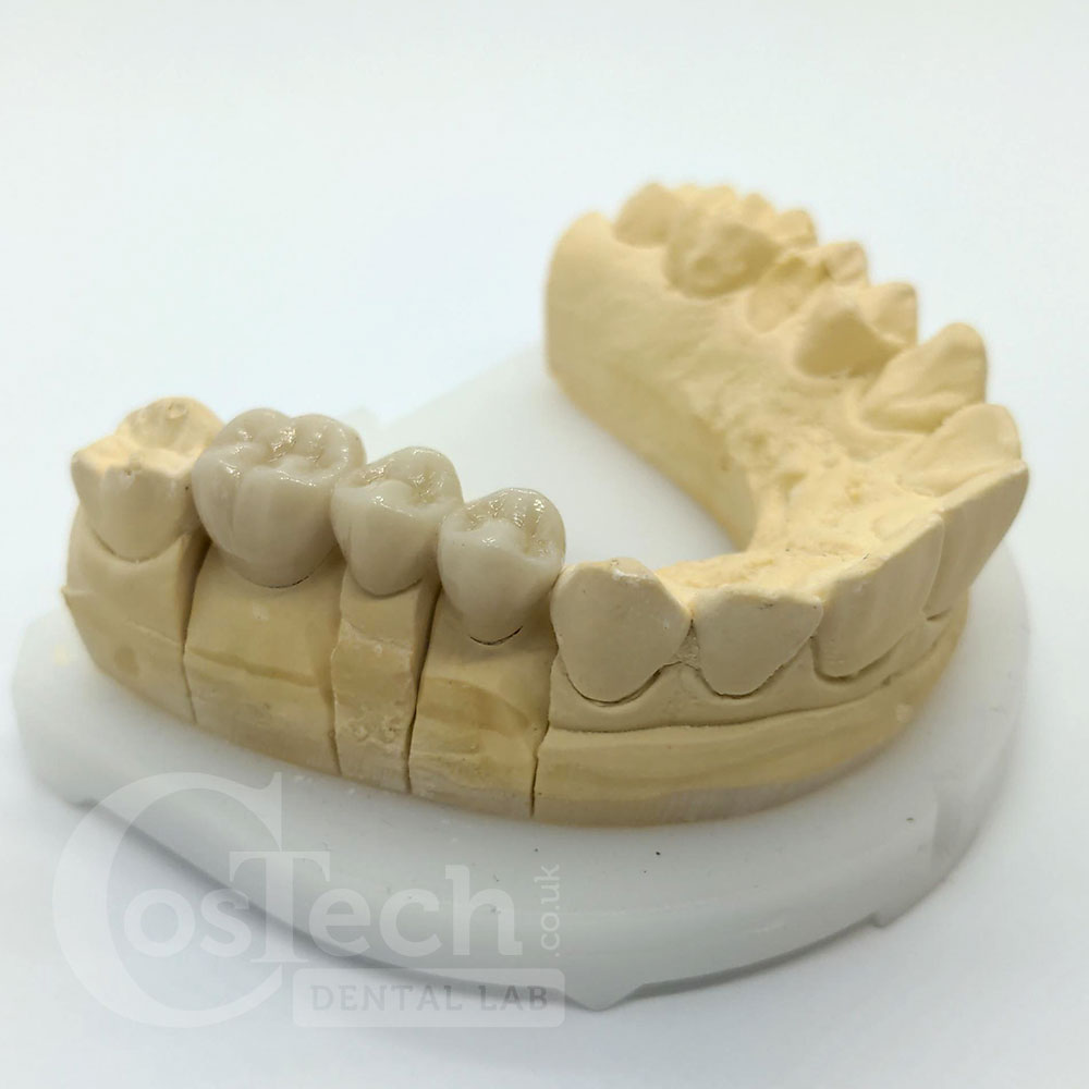 Demonstration Model: BruxZir Bridge