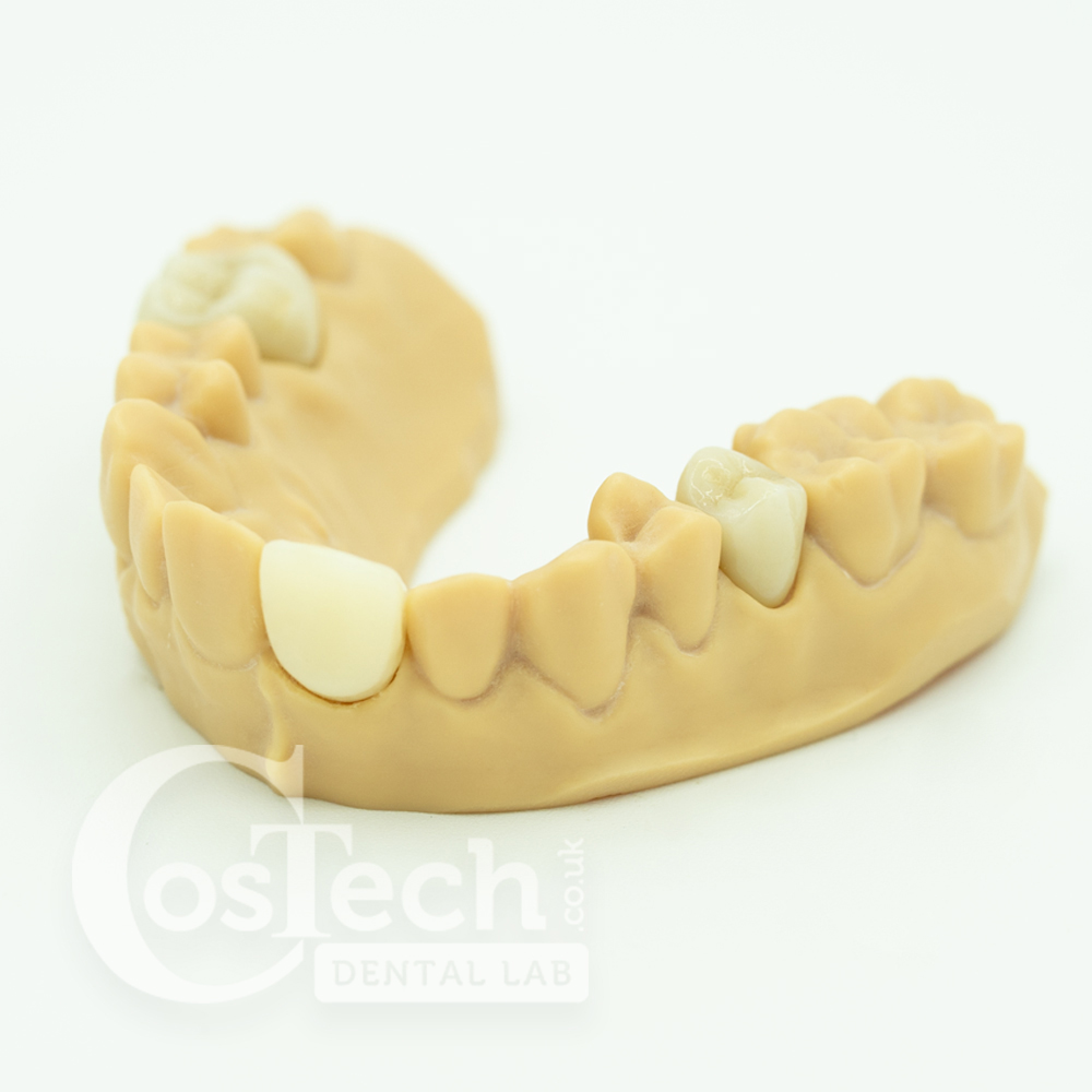 Demo Model - BruxZir Crowns