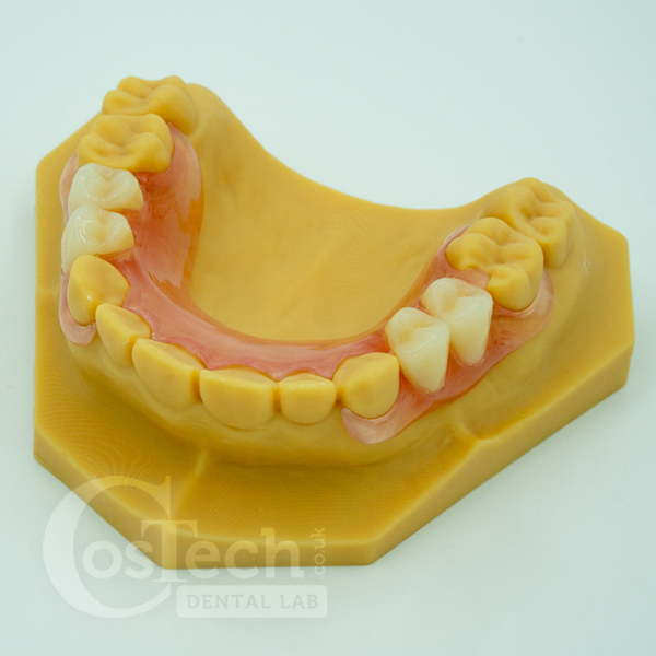 Demo Model – Flexible Partial Denture